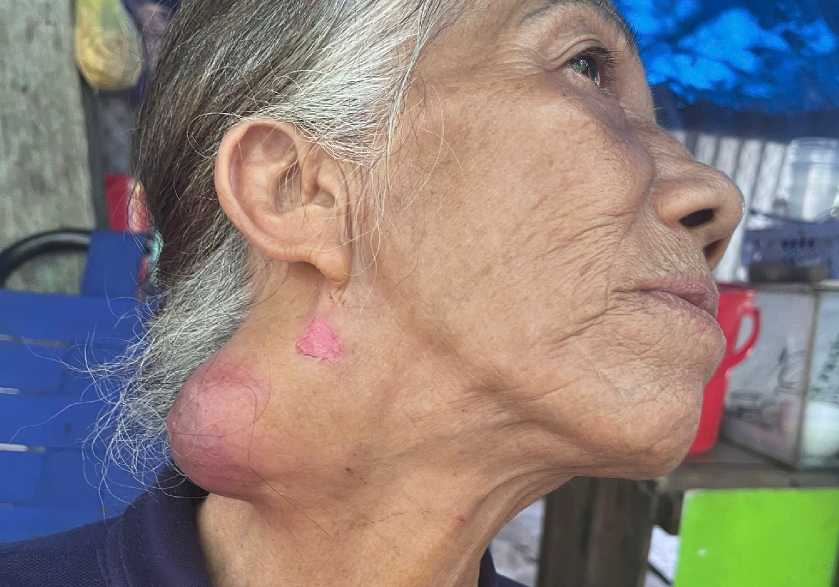 KÊU GỌI ỦNG HỘ GIÚP ĐỠ CỤ BÀ HƯƠNG 68T, KHÔNG NHÀ CỬA, BỊ UNG BƯỚU